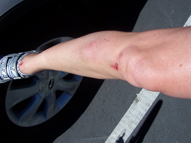 How is Road Rash Categorized and Treated (and How Serious Can It Be