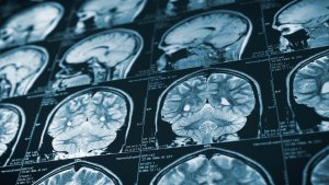 Brain Injury Causes Symptoms And Treatments 300x169