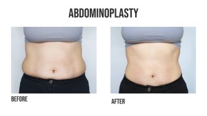What To Consider Before Getting A Tummy Tuck 300x169
