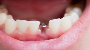 Why Choose Dental Implants Over Dentures 300x169
